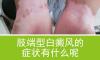 肢端型白癜風(fēng)癥狀表現(xiàn)是什么?北京最好白癜風(fēng)醫(yī)院