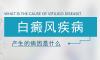 北京治白癜風(fēng)醫(yī)院講解什么情況會(huì)導(dǎo)致白癜風(fēng)的復(fù)發(fā)